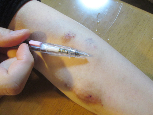 ムックンの針あと。今は16ゲージ