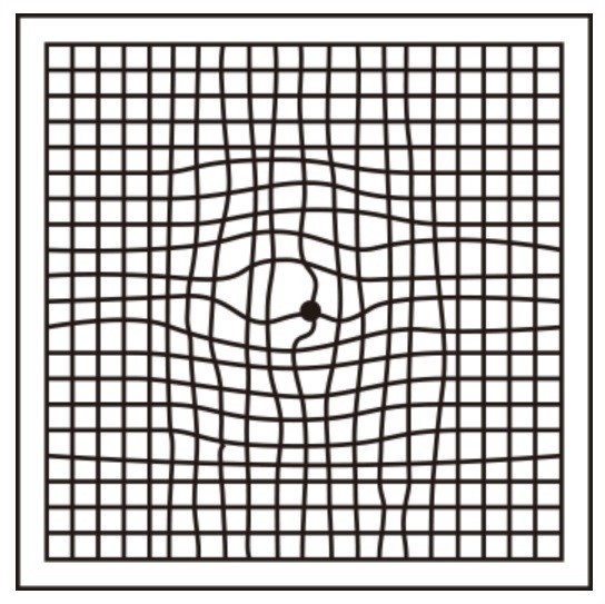 「黄斑変性」！？　持病が増えていく。。